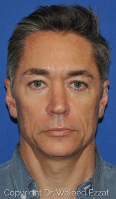 Blepharoplasty Patient Photo - Case 4715 - after view-0