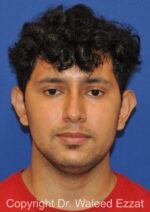 Otoplasty (Ear Re-Shaping Surgery) - Case 3144 - Before