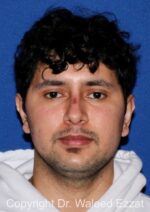 Otoplasty (Ear Re-Shaping Surgery) - Case 3144 - After