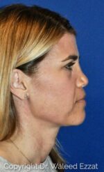 Caucasian/European Rhinoplasty - Case 114 - Before