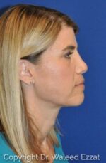 Caucasian/European Rhinoplasty - Case 114 - After
