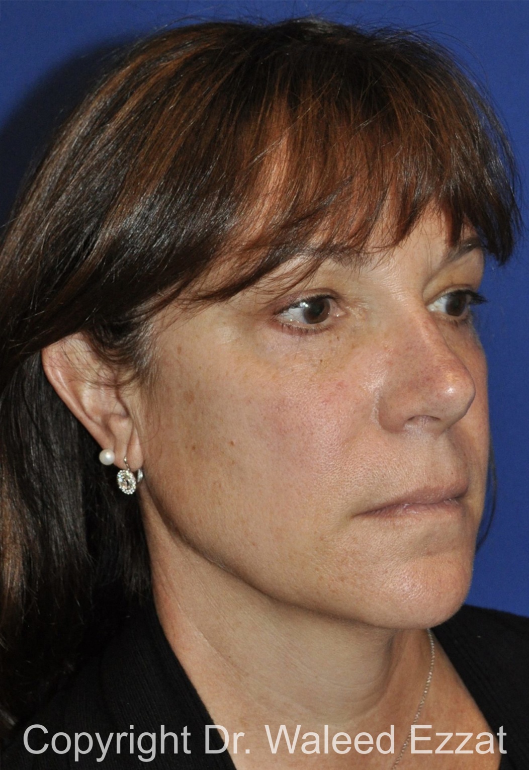 Cheek Lift Patient Photo - Case 1201 - before view-1