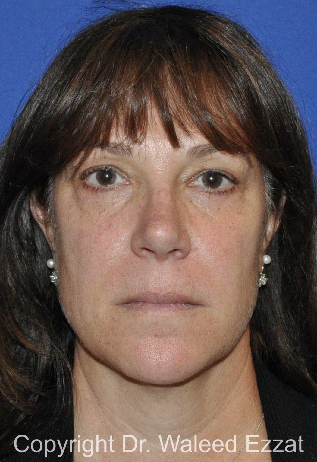 Cheek Lift Patient Photo - Case 1201 - before view-2