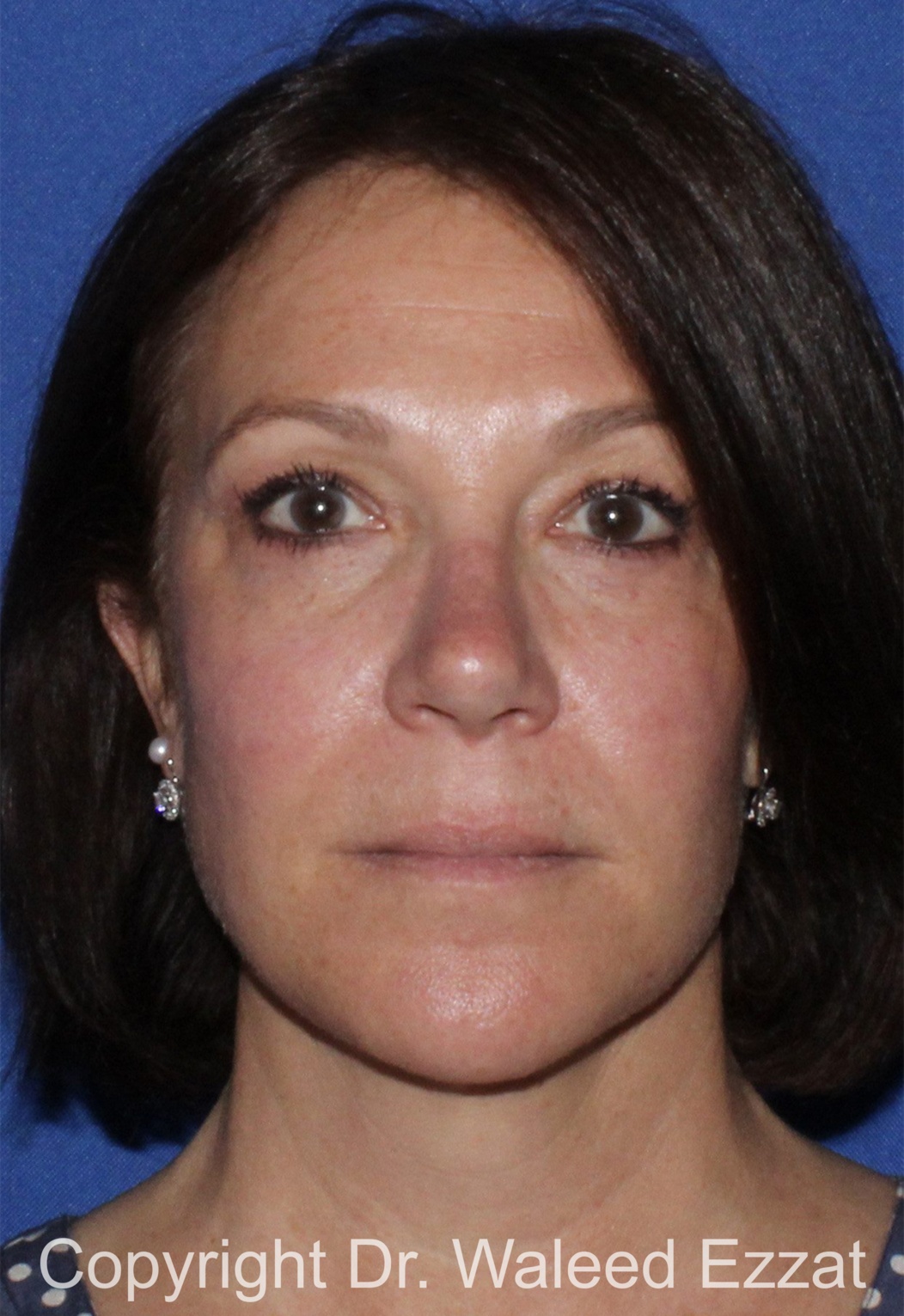 Cheek Lift Patient Photo - Case 1201 - after view-2