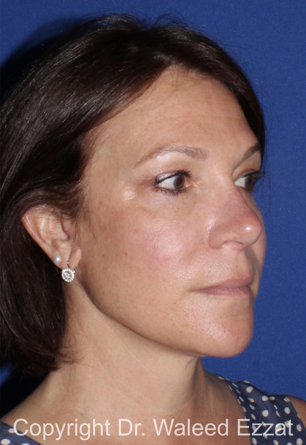 Cheek Lift Patient Photo - Case 1201 - after view-1