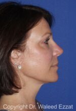 Cheek Lift - Case 1201 - After