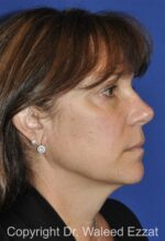 Cheek Lift - Case 1201 - Before