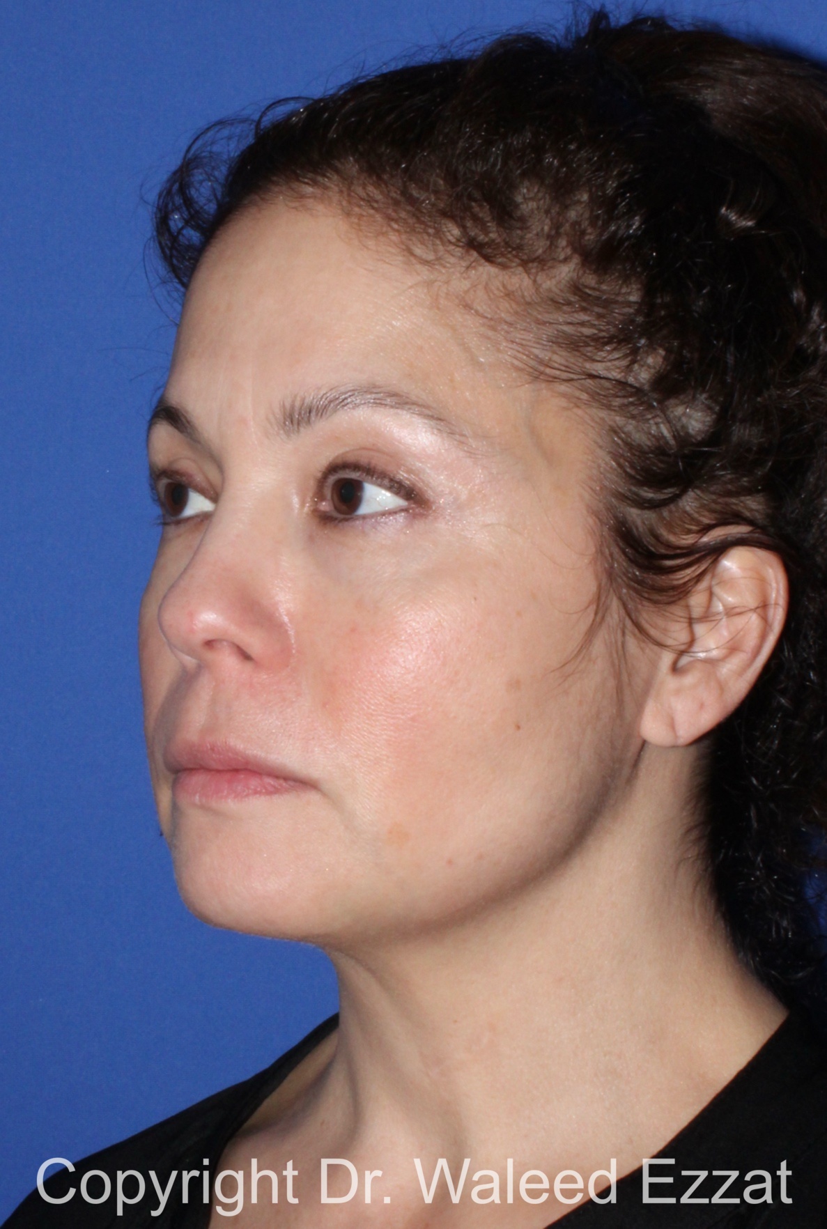 Blepharoplasty Patient Photo - Case 11 - after view-1