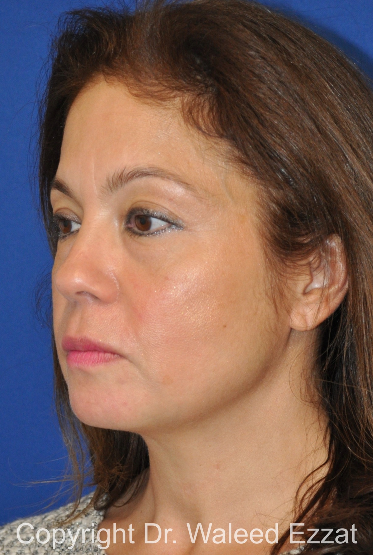 Blepharoplasty Patient Photo - Case 11 - before view-1