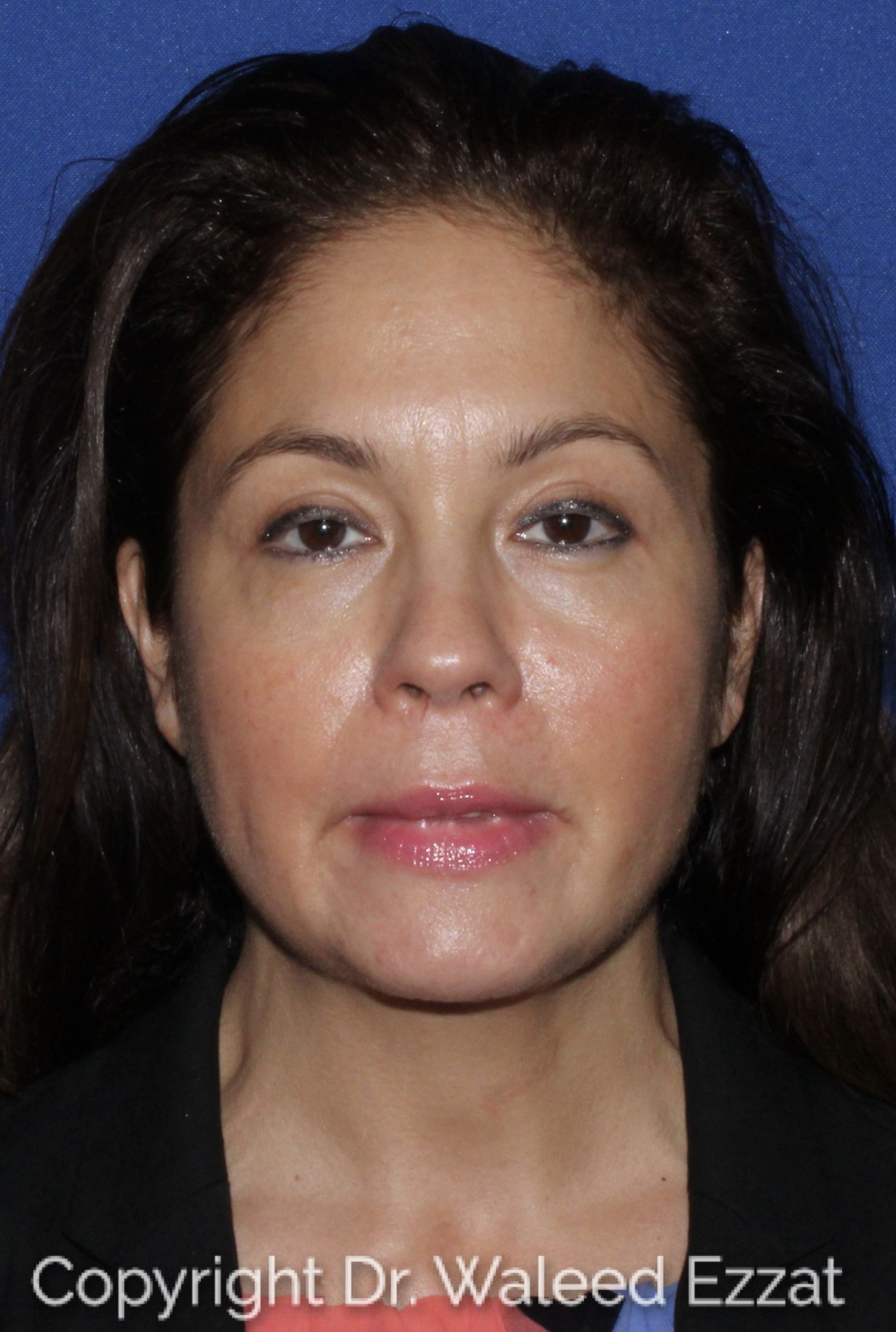 Blepharoplasty Patient Photo - Case 1301 - after view