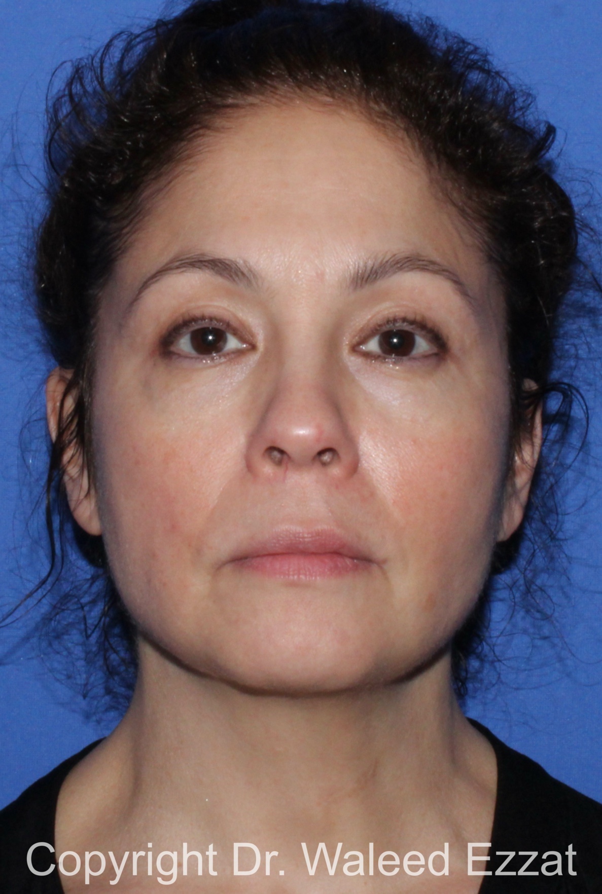 Blepharoplasty Patient Photo - Case 11 - after view-2