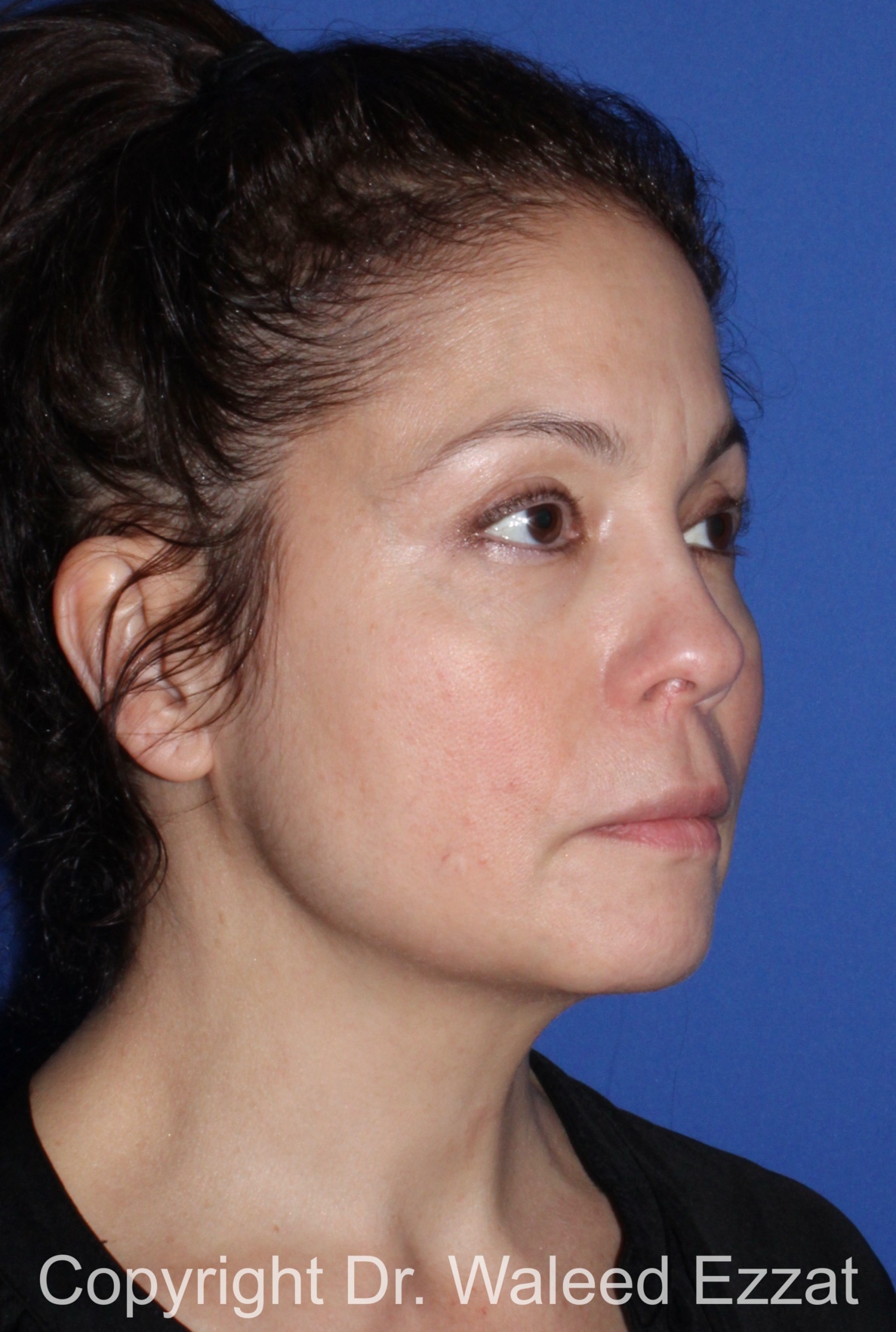 Cheek Lift Patient Photo - Case 11 - after view
