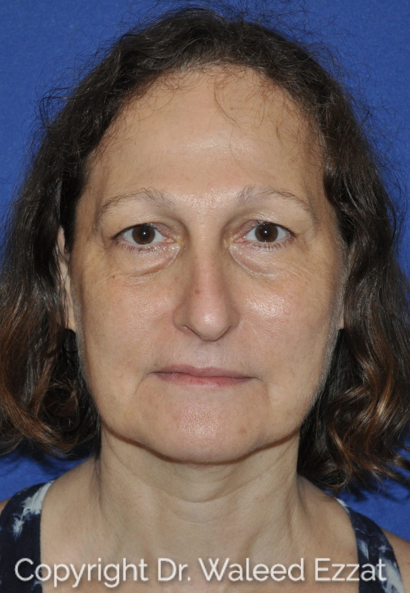 Blepharoplasty Patient Photo - Case 4716 - before view-