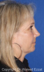 Caucasian/European Rhinoplasty - Case 341 - After