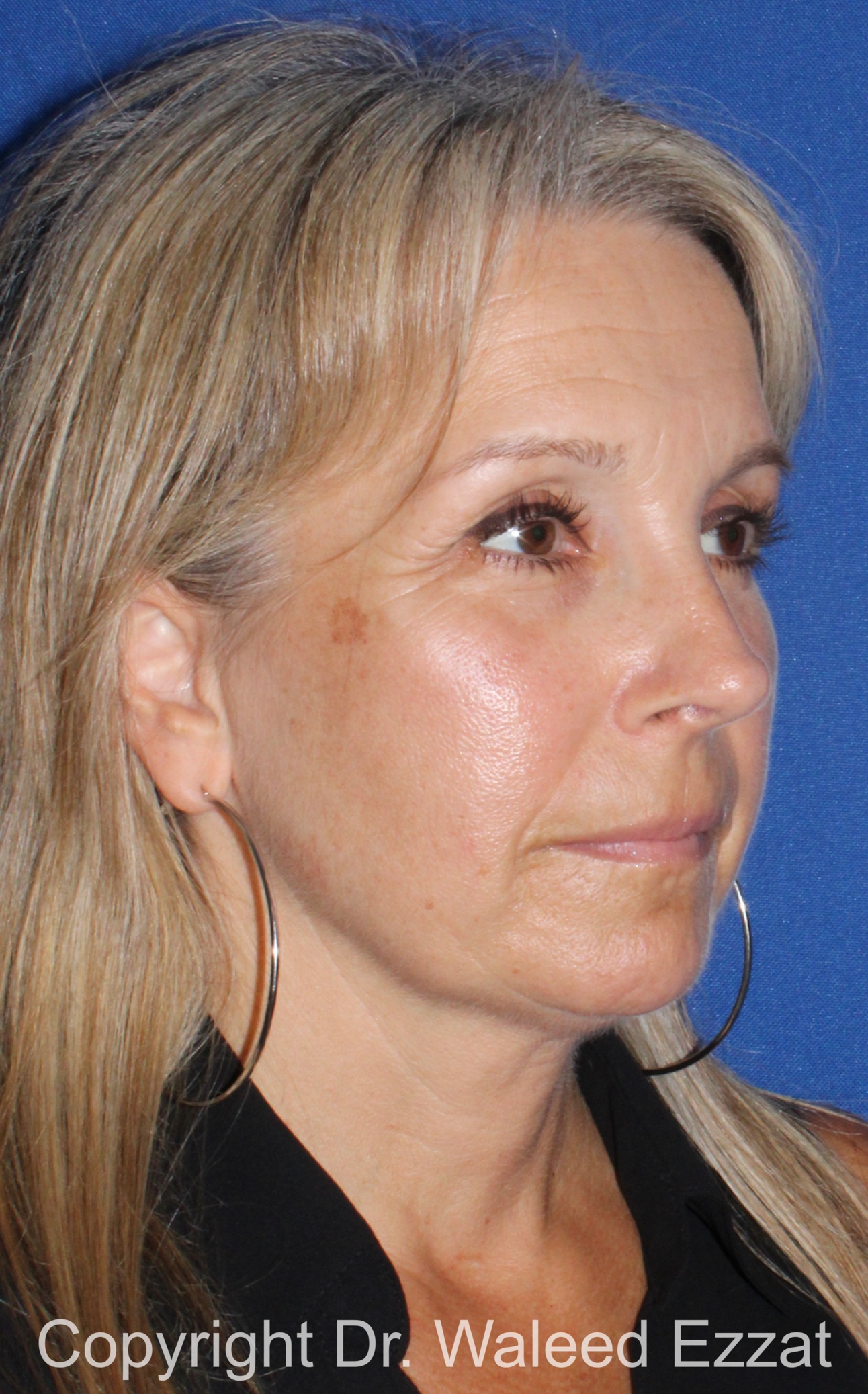 Rhinoplasty Patient Photo - Case 341 - after view-1