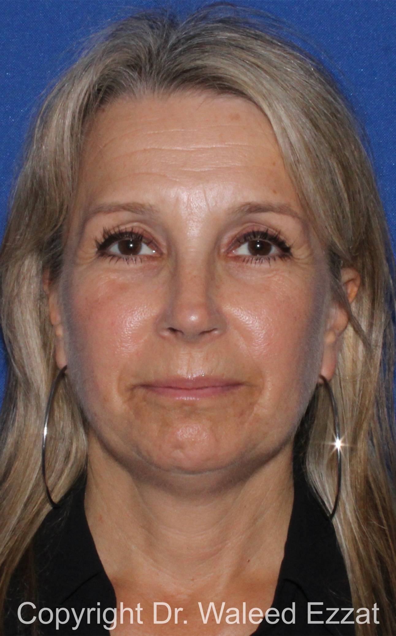 Rhinoplasty Patient Photo - Case 341 - after view-2