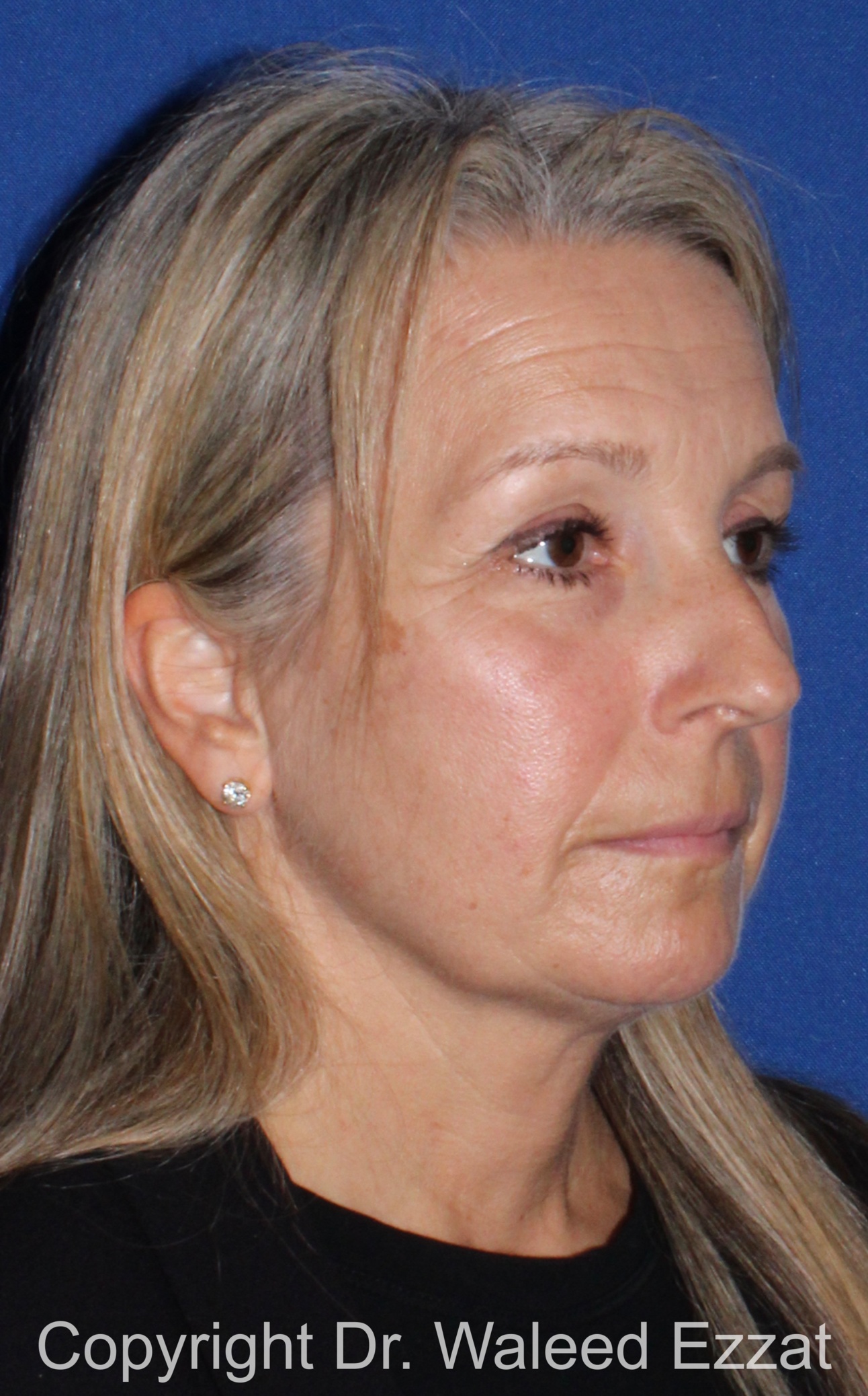 Rhinoplasty Patient Photo - Case 341 - before view-1