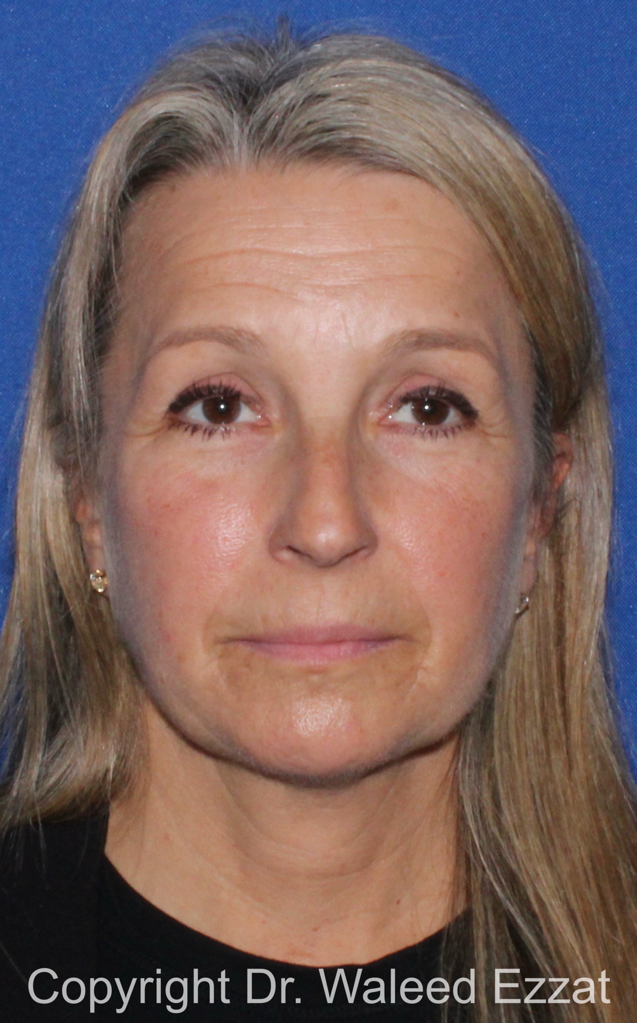 Rhinoplasty Patient Photo - Case 341 - before view-2