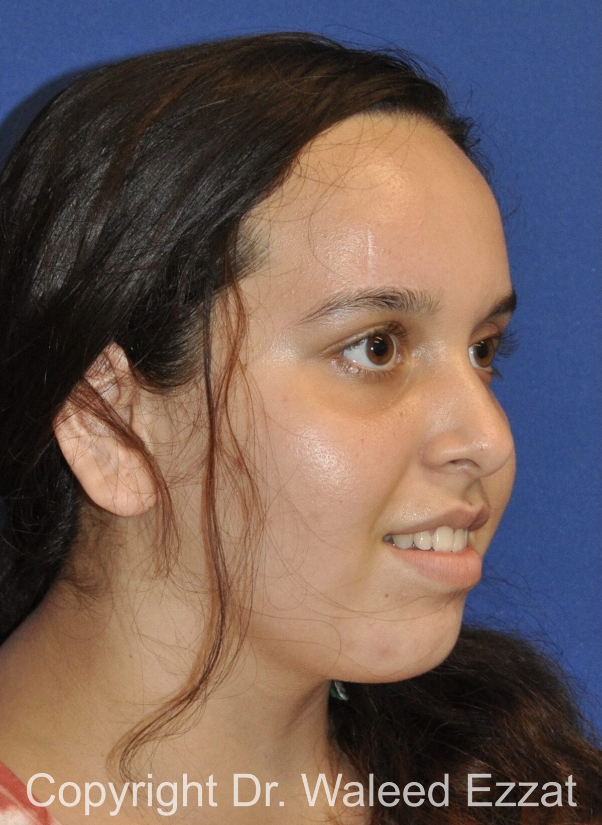 Mole Removal Patient Photo - Case 5301 - after view-1