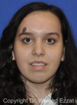 Mole Removal - Case 5301 - Before