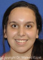 Mole Removal - Case 5301 - After