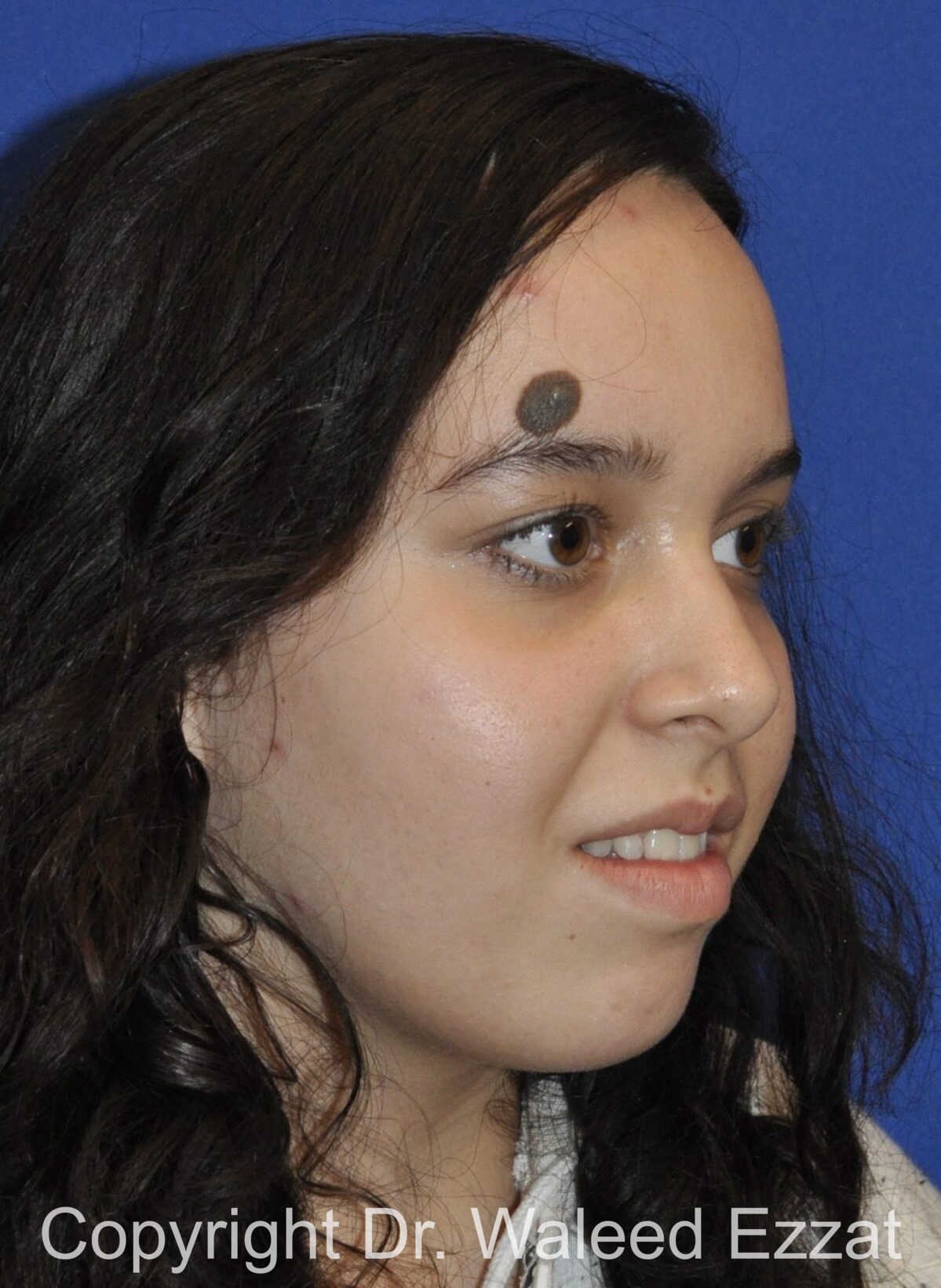 Mole Removal Patient Photo - Case 5301 - before view-1