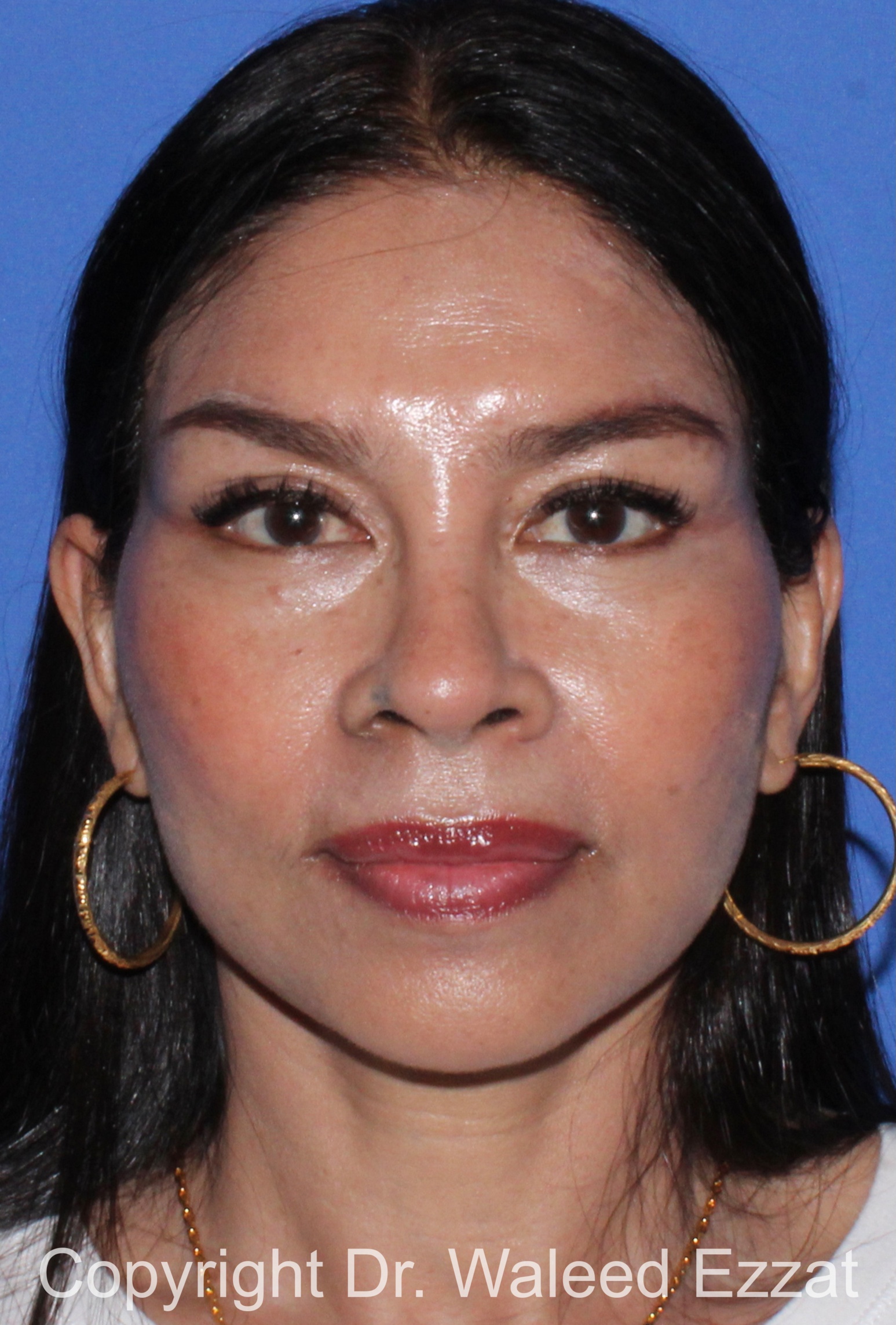 East Asian Rhinoplasty Patient Photo - Case 213 - after view-2