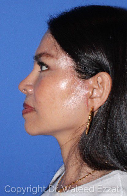 East Asian Rhinoplasty Patient Photo - Case 61 - after view