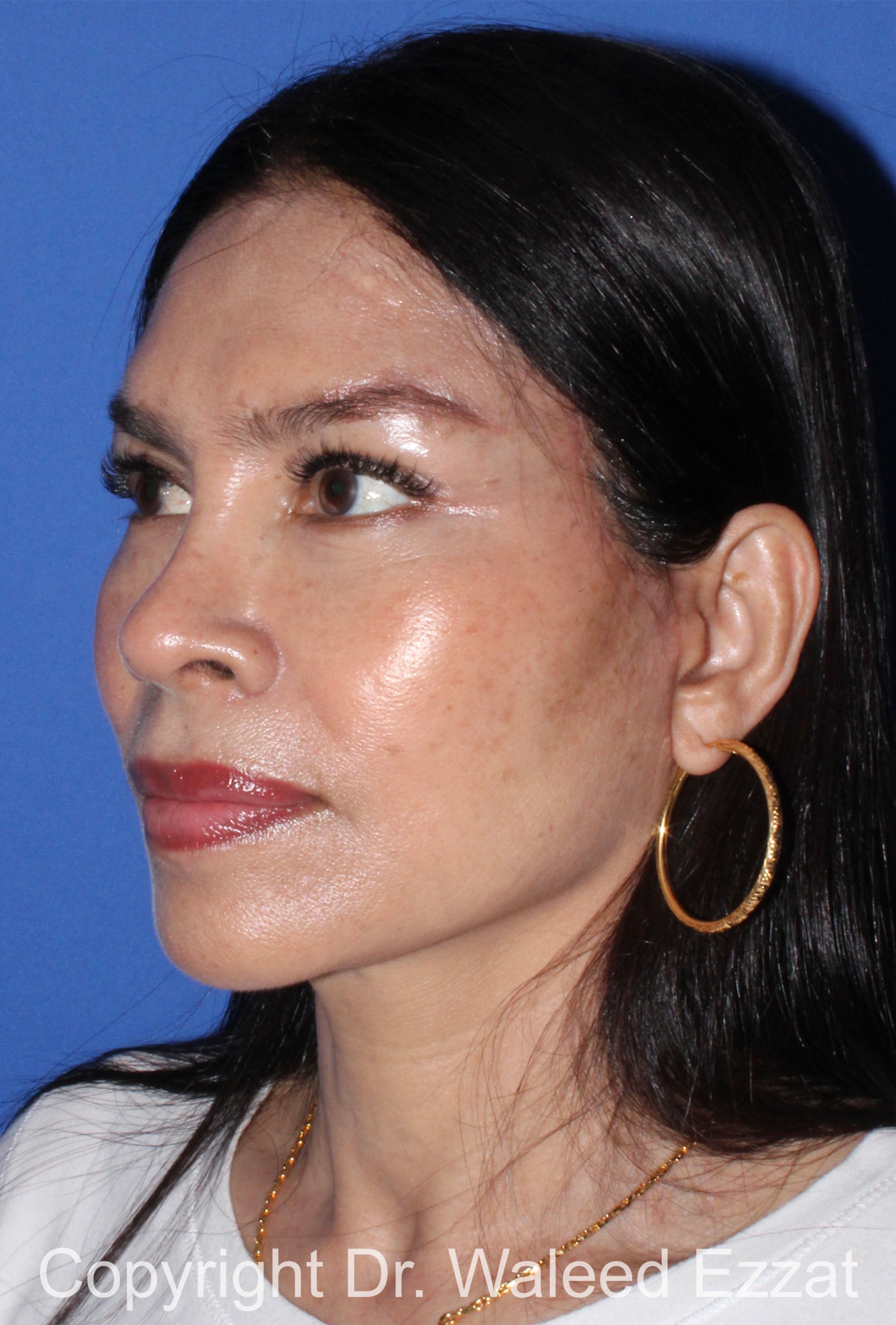 East Asian Rhinoplasty Patient Photo - Case 213 - after view-1