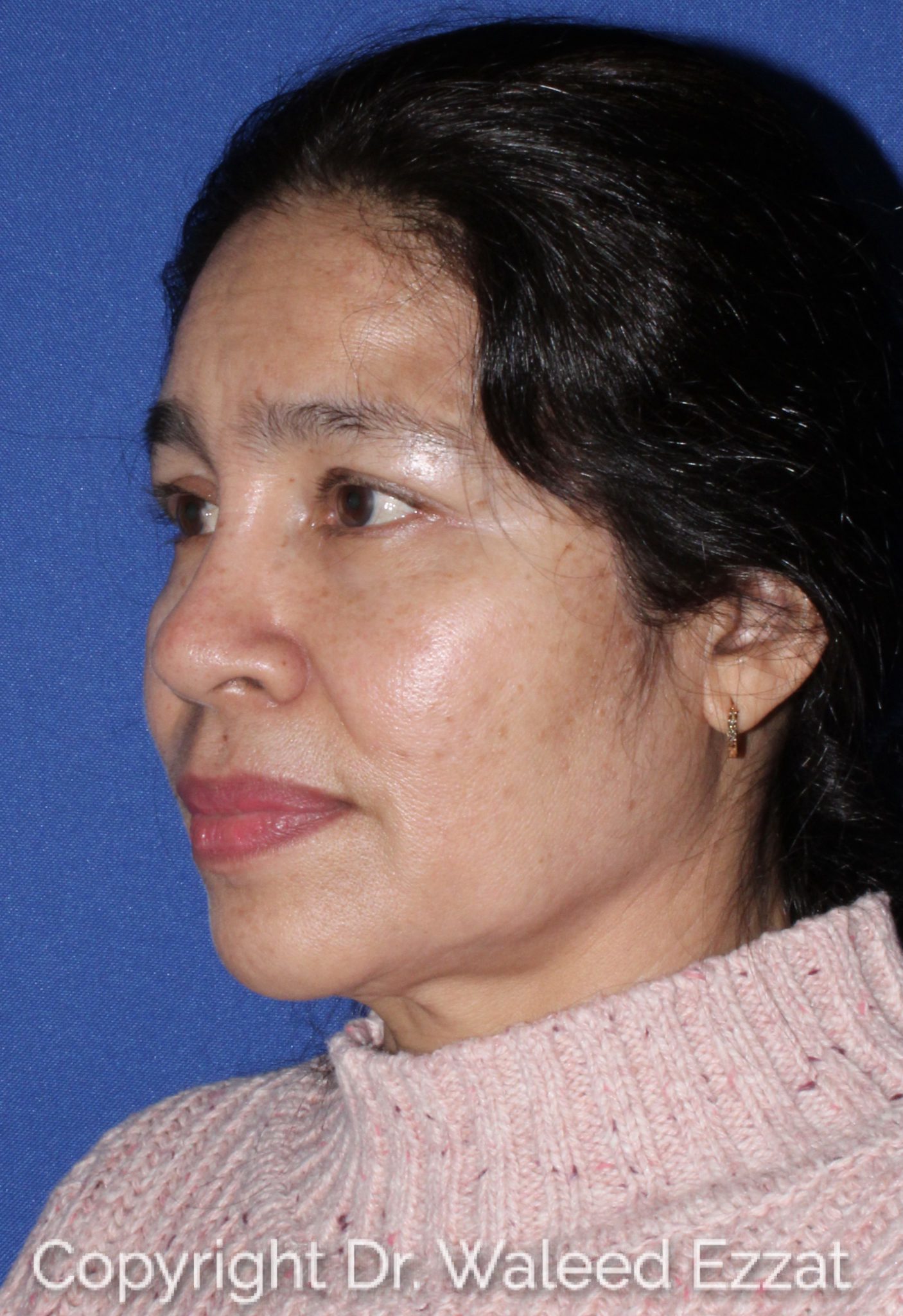 East Asian Rhinoplasty Patient Photo - Case 61 - before view-1