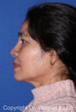 East Asian Rhinoplasty - Case 213 - Before