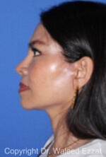 East Asian Rhinoplasty - Case 213 - After