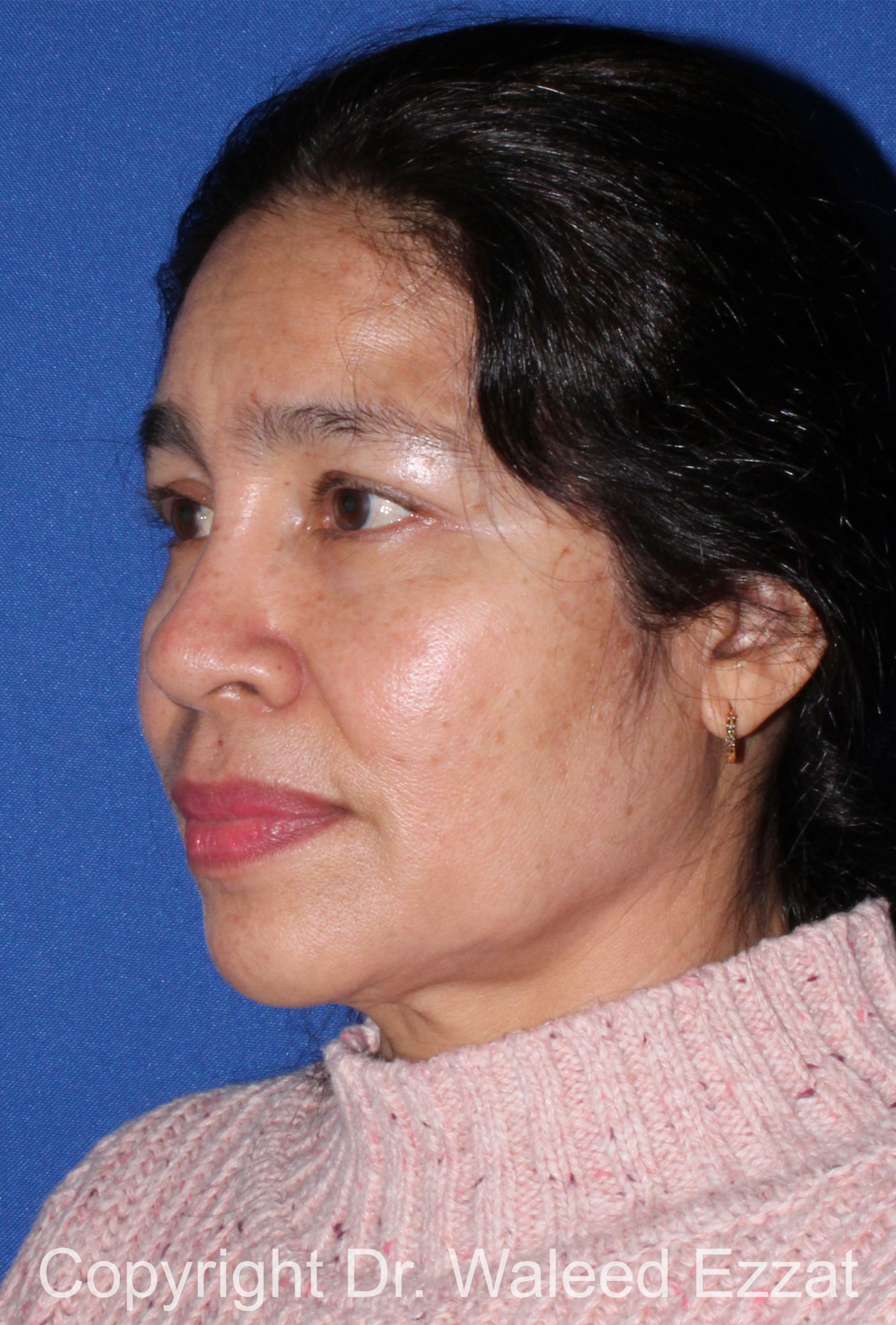 East Asian Rhinoplasty Patient Photo - Case 213 - before view-1