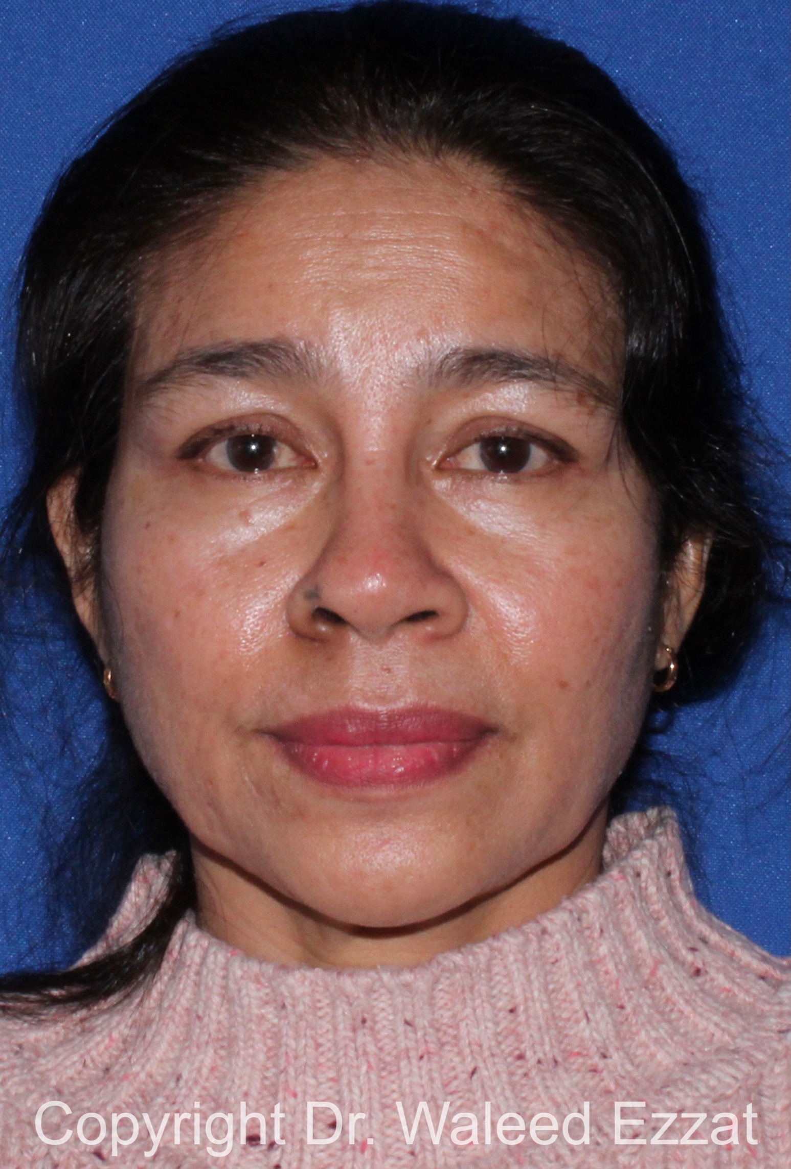 East Asian Rhinoplasty Patient Photo - Case 213 - before view-2