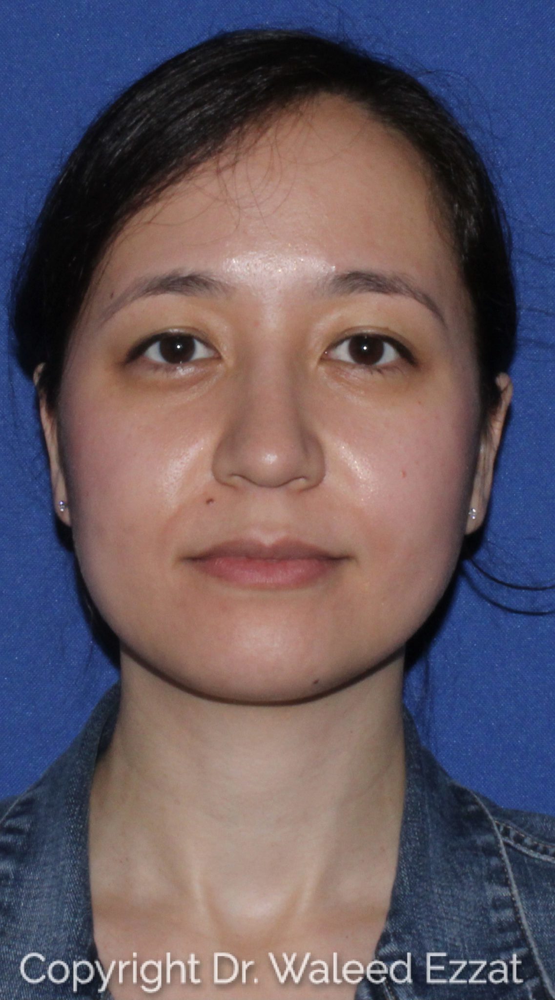East Asian Rhinoplasty Patient Photo - Case 62 - after view-2