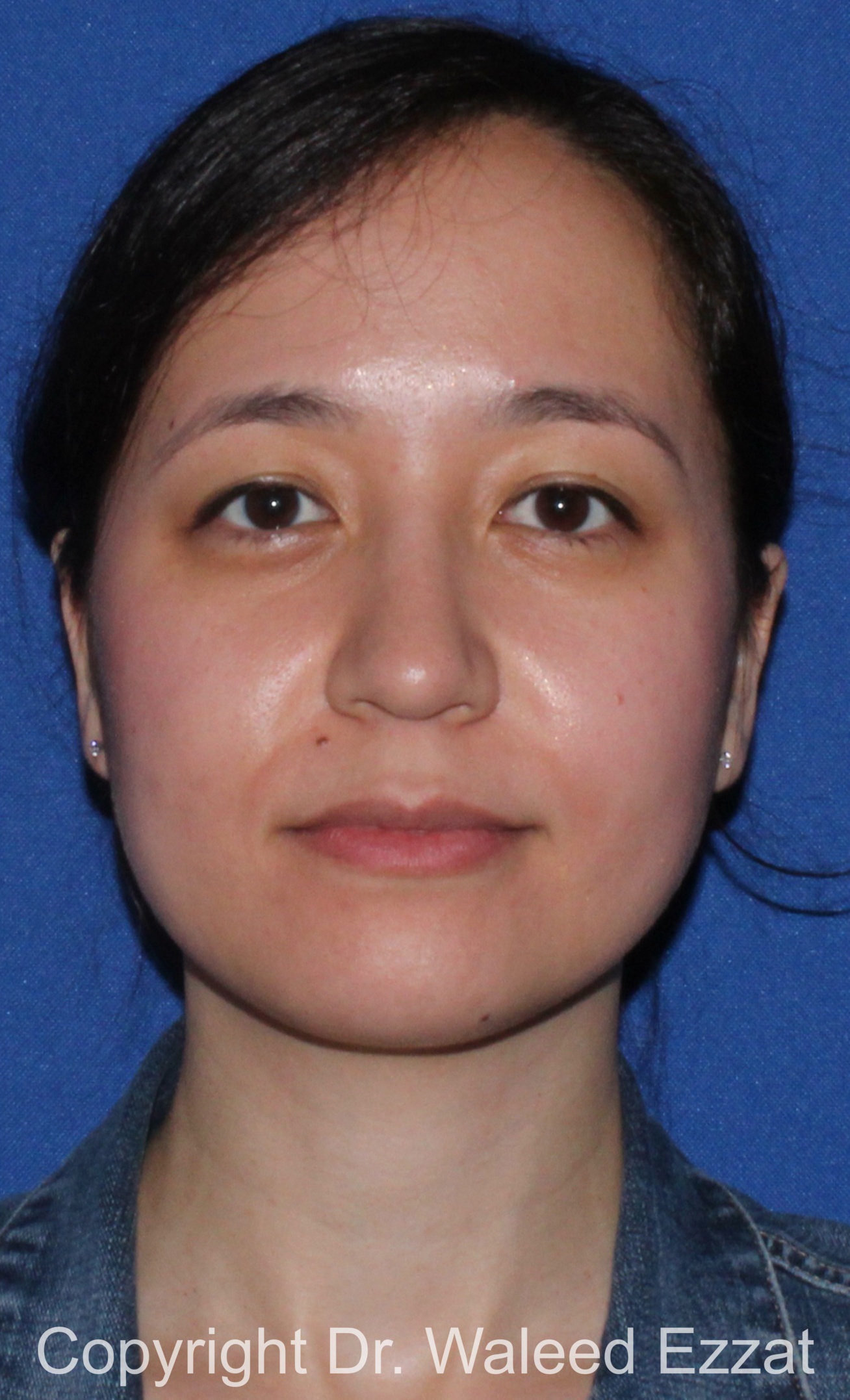 East Asian Rhinoplasty Patient Photo - Case 218 - after view-2