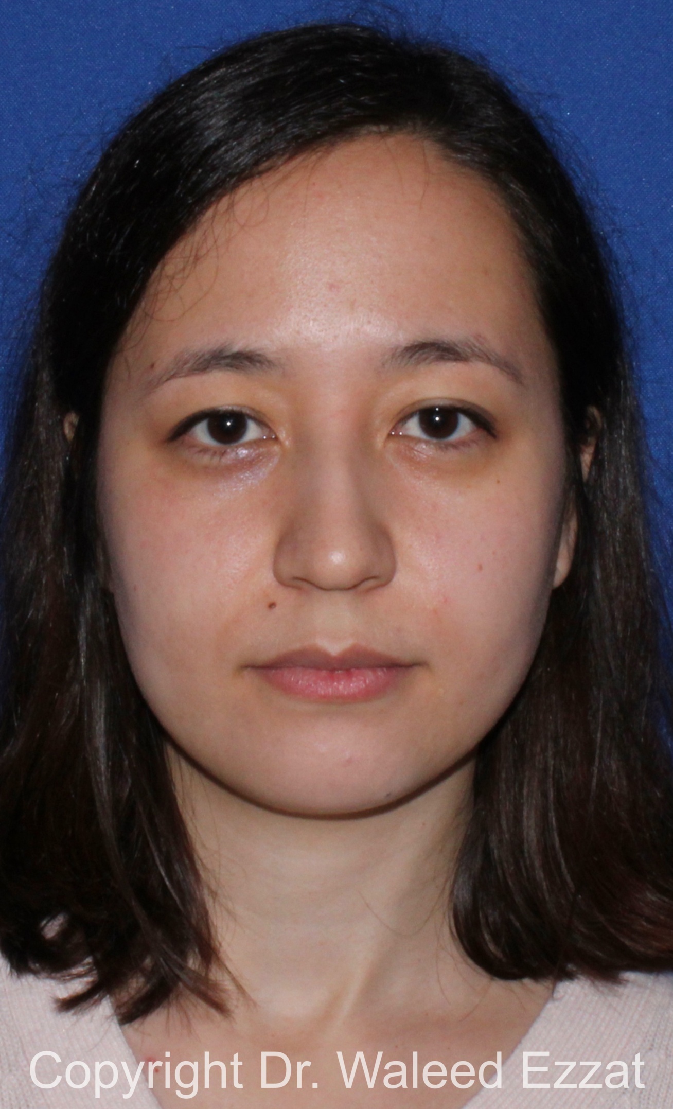 East Asian Rhinoplasty Patient Photo - Case 218 - before view-2