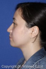 East Asian Rhinoplasty - Case 62 - After