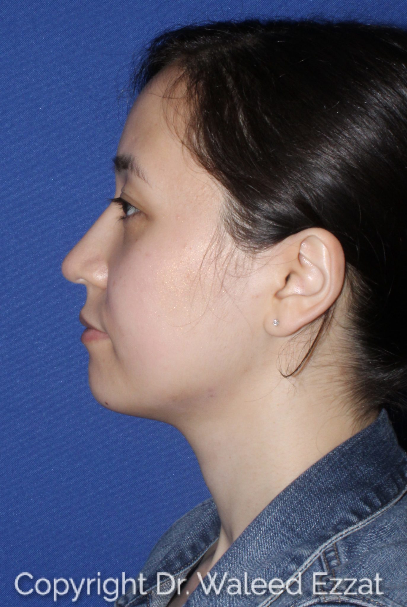 East Asian Rhinoplasty Patient Photo - Case 62 - after view