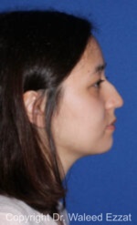 East Asian Rhinoplasty - Case 218 - Before