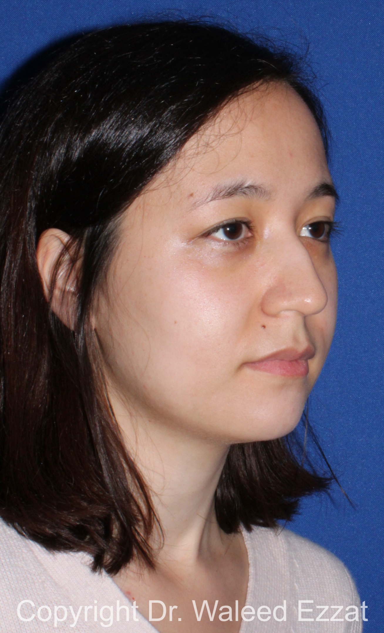 East Asian Rhinoplasty Patient Photo - Case 218 - before view-1