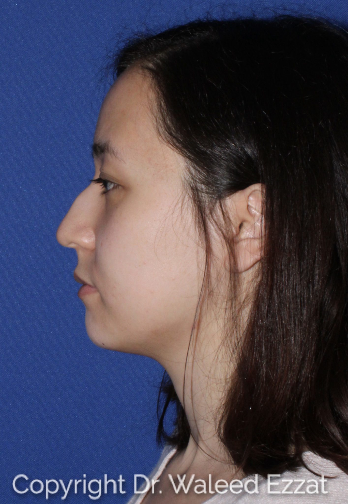 East Asian Rhinoplasty Patient Photo - Case 62 - before view-0