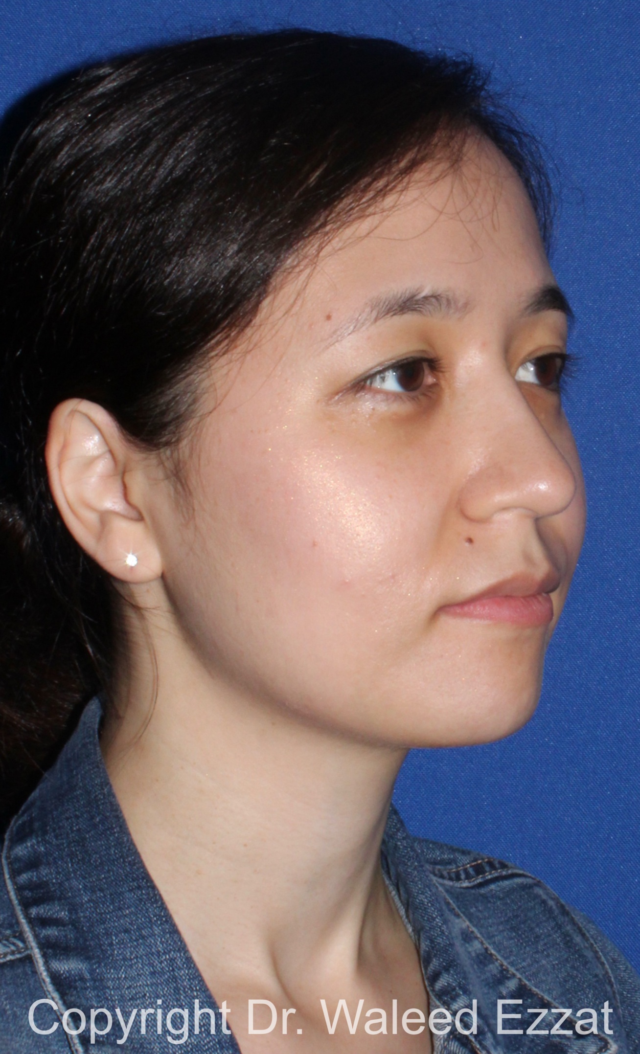East Asian Rhinoplasty Patient Photo - Case 218 - after view-1