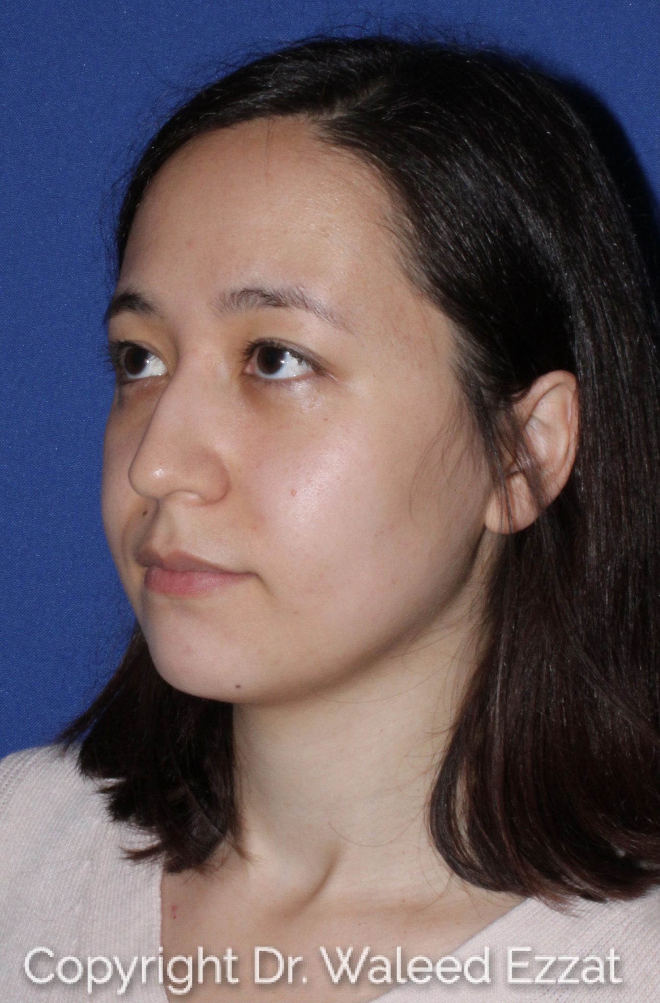 East Asian Rhinoplasty Patient Photo - Case 62 - before view-1