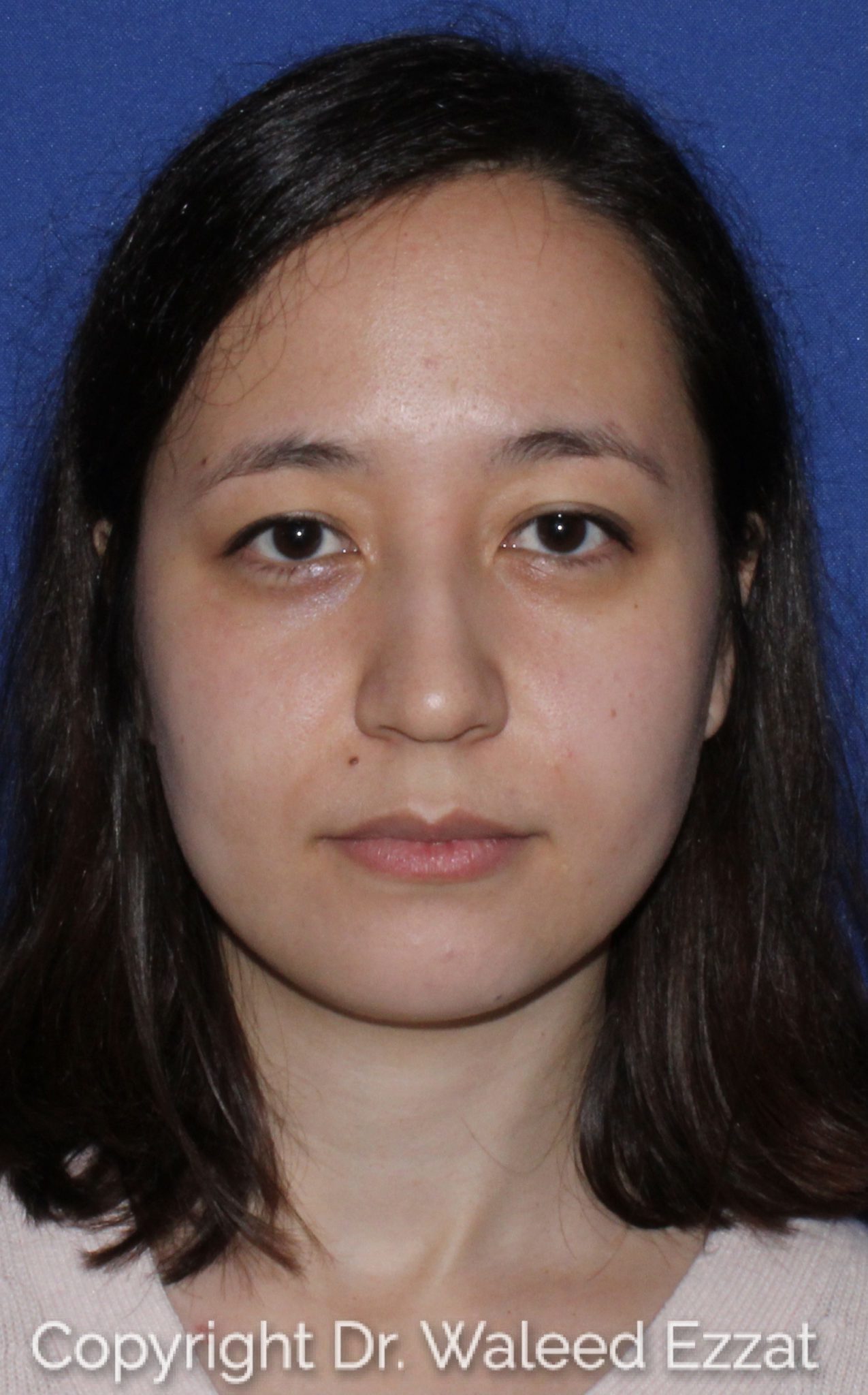 East Asian Rhinoplasty Patient Photo - Case 62 - before view-2