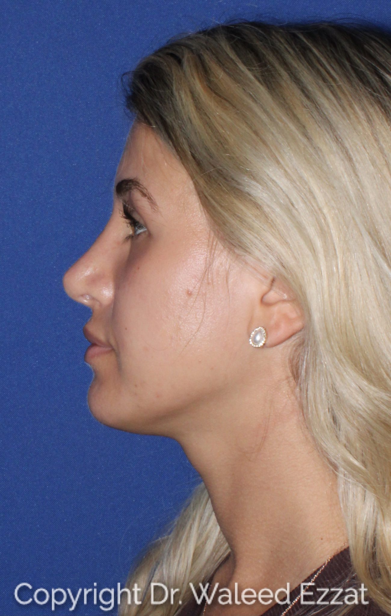 Mediterranean/Middle Eastern Rhinoplasty Patient Photo - Case 29 - after view