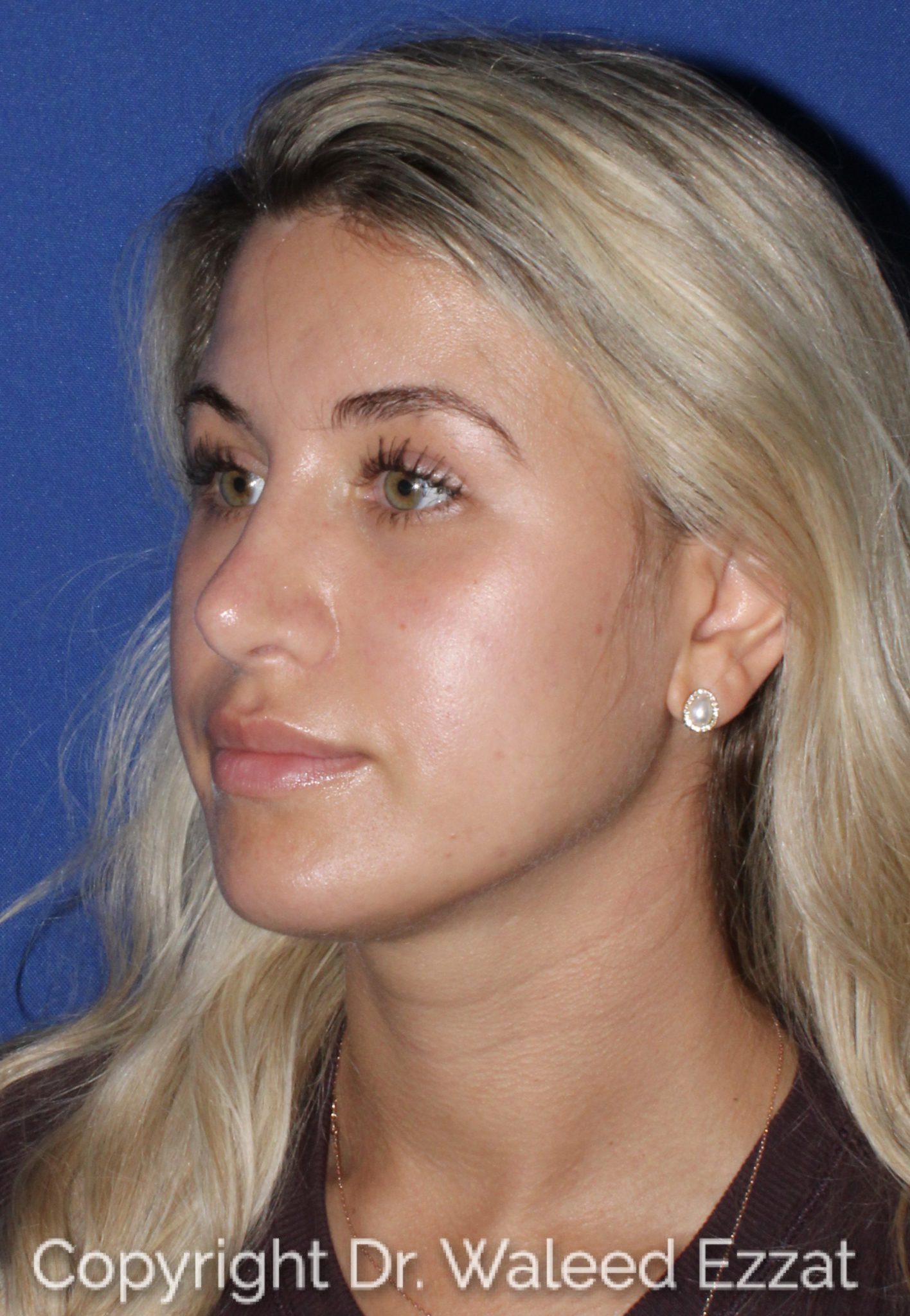 Mediterranean/Middle Eastern Rhinoplasty Patient Photo - Case 29 - after view-1