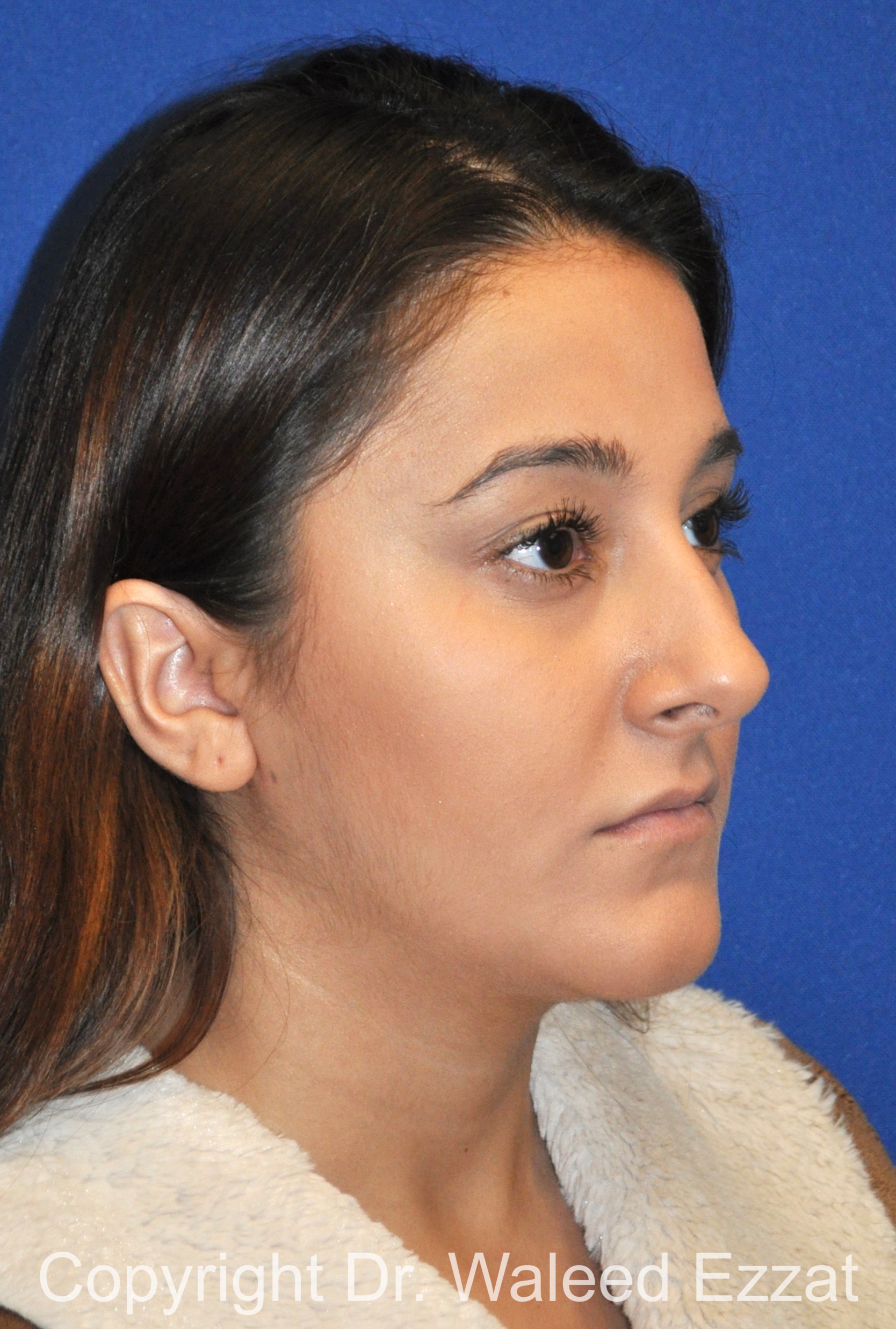 Hispanic/South American Rhinoplasty Patient Photo - Case 294 - before view-1