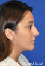 Hispanic/South American Rhinoplasty - Case 294 - Before