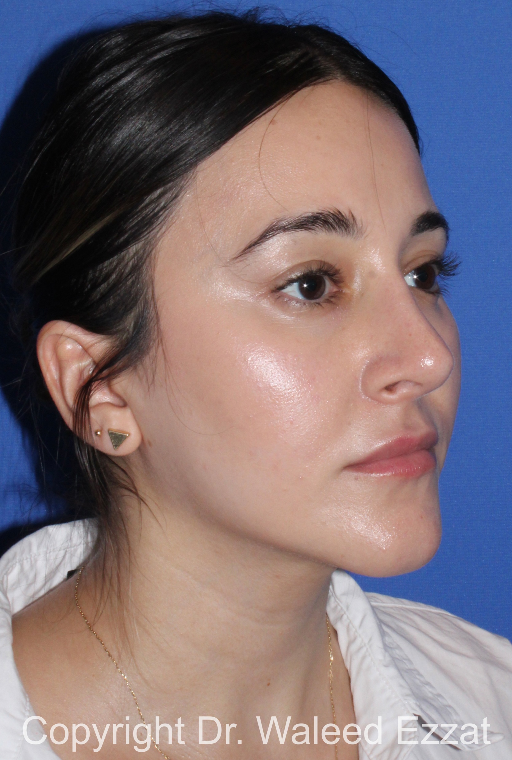 Hispanic/South American Rhinoplasty Patient Photo - Case 294 - after view-1